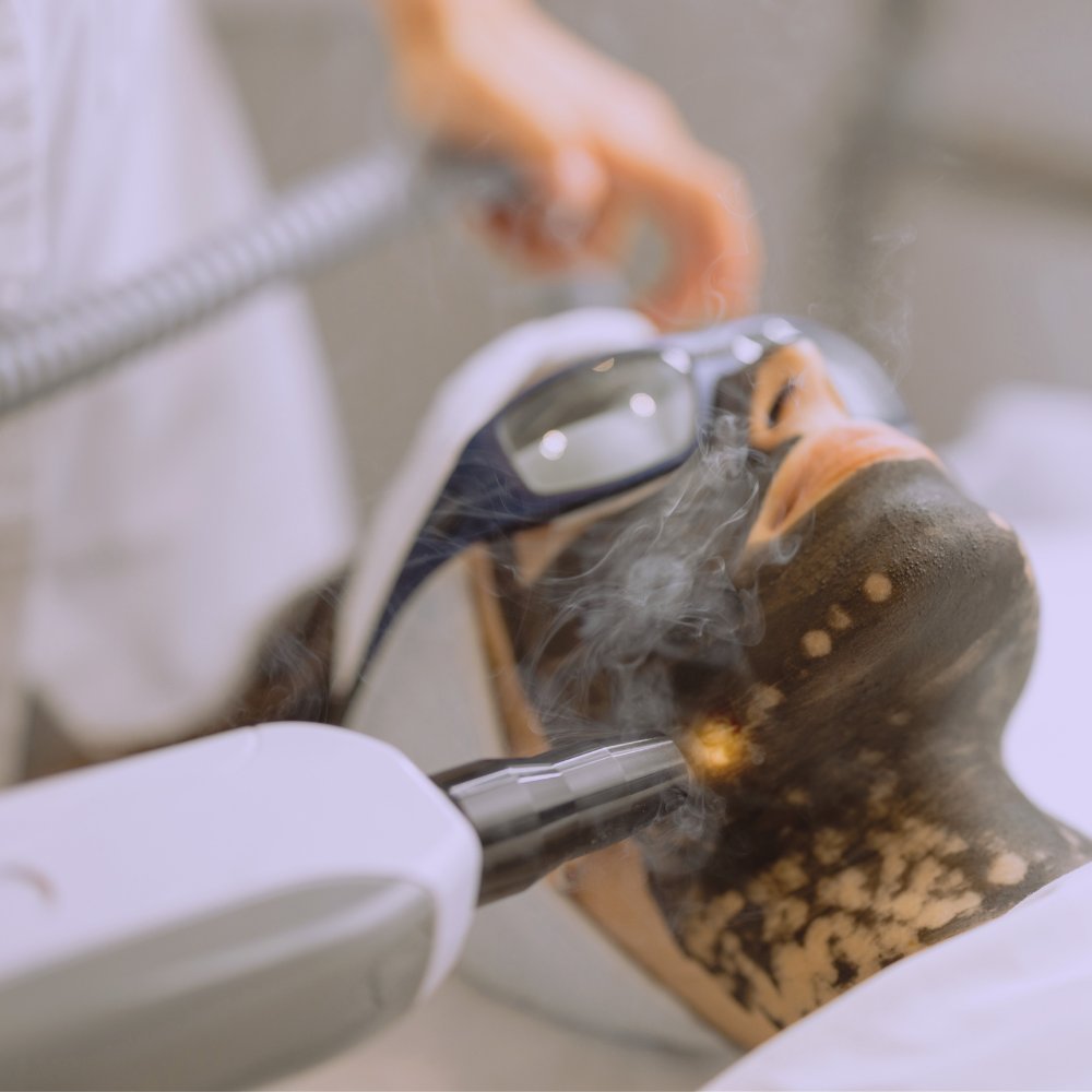 Laser Facial Laser Facial